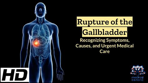 Rupture of Gallbladder: Causes, Symptoms & Diagnosis